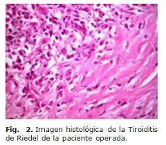 Tiroidite di Riedel (istologia)